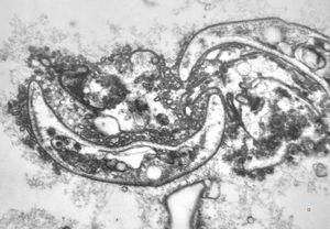 M,50y. | Pneumocystis carinii - lung M,50y. | Pneumocystis carinii - lung